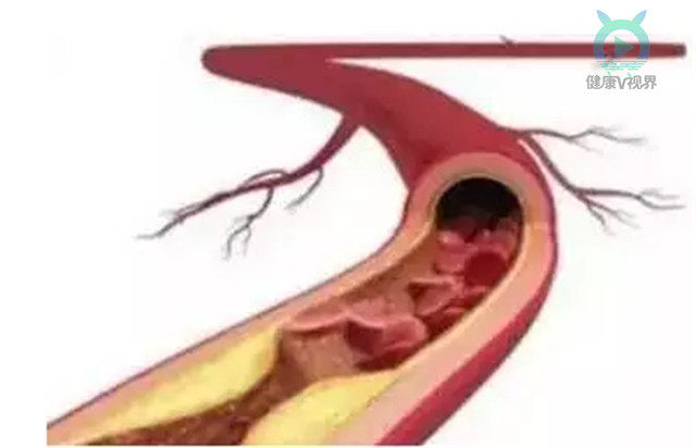 早点“养”血管，胜于老来“治”