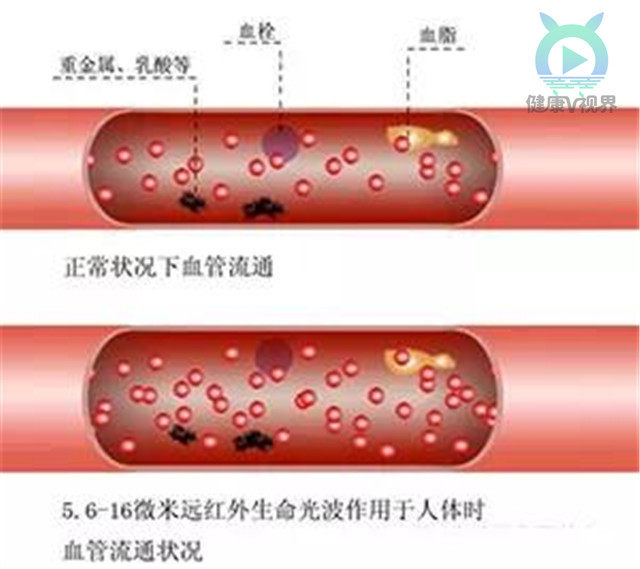 血管是如何一天天堵塞的